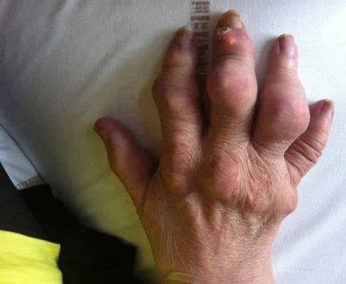 Подагра – что вам следует знать