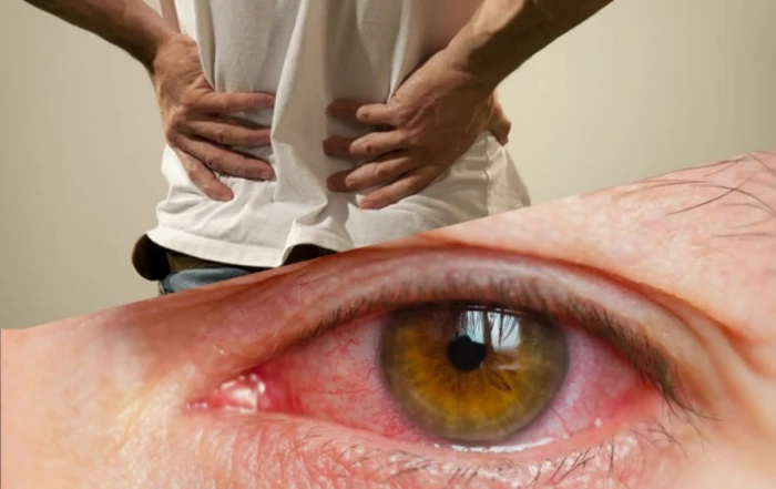 Воспаление глаз, суставов и позвоночника – что общего?