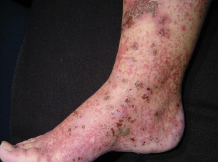 Васкулит пожелого возраста